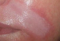 Hyaluronsäure für die Lippen: Bewertungen, Fotos vor und nach