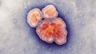 el virus del sarampión