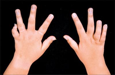 die Behandlung von Arthritis der Hände