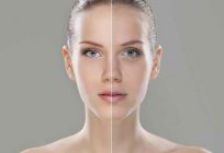 Botulinum toxin in cosmetics: types, application, reviews, photos