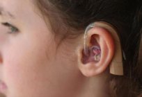 Rumor: el de la reparación de la pérdida auditiva neurosensorial, después de la otitis media, después de la operación de los niños