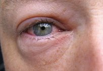 If swollen eyes, the causes may be different. This applies both to adults and to children