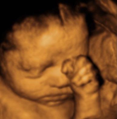 Determination of the child's sex by ultrasound