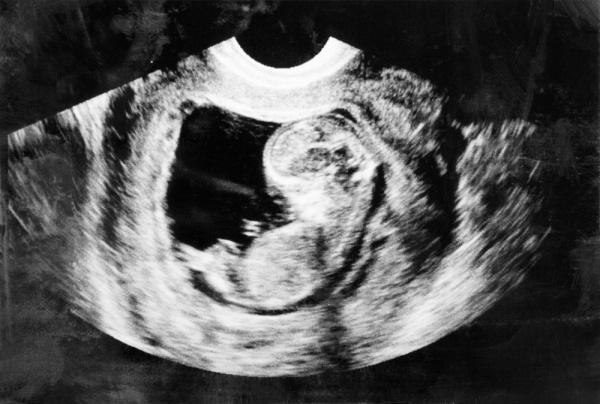 pregnancy baby sex determination ultrasound