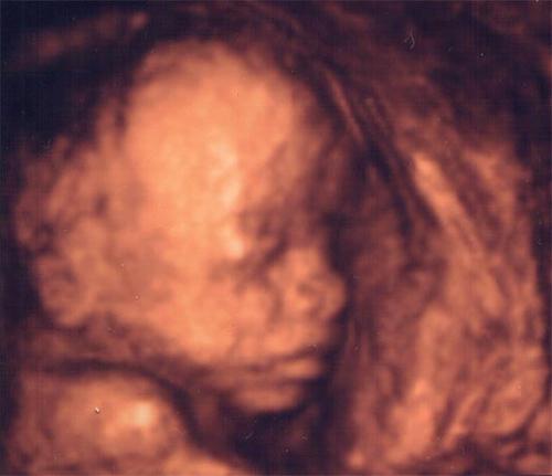 ultrasound child sex determination photo