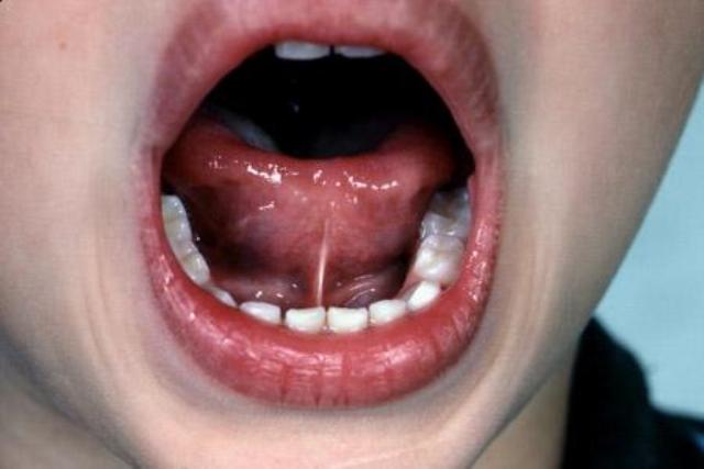 la brida de la lengua