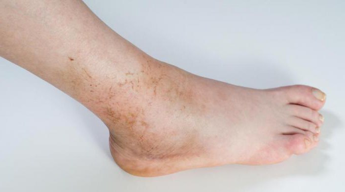 治療のsynovitisの足関節