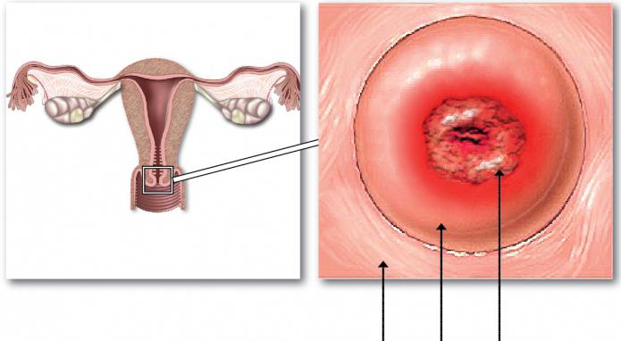 Precancerous condition of the cervix