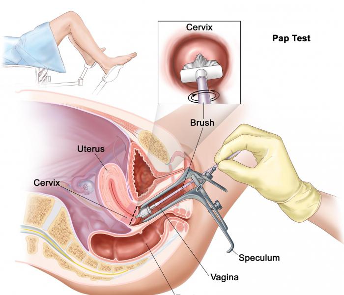 Cauterizing the cervix