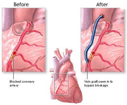 : revascularização do miocárdio cirurgia do coração