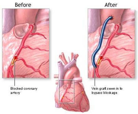 冠状动脉旁路移植的心脏