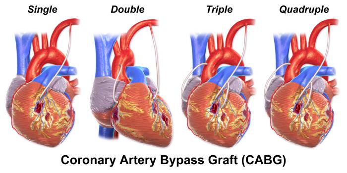 a cirurgia de bypass coração de preço