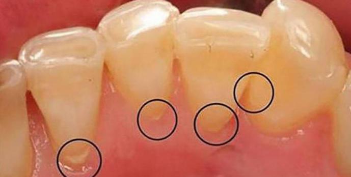 warum erscheint Zahnstein auf den Zähnen