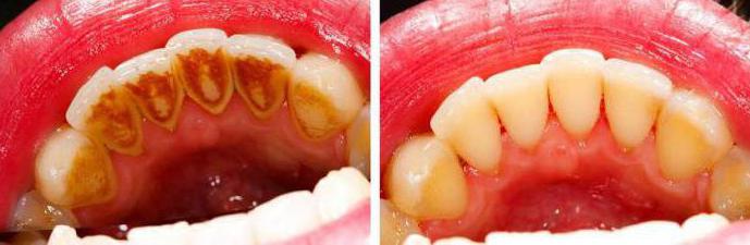 ne alırsınız diş taşı nedenleri оброзования
