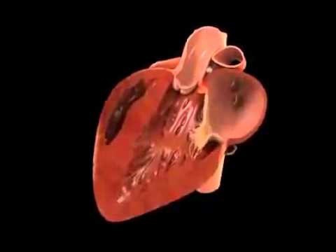 2 flügelelement ist kippbar Herzklappe