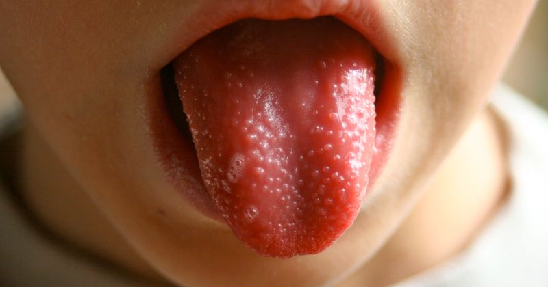 signs of scarlet fever in a child