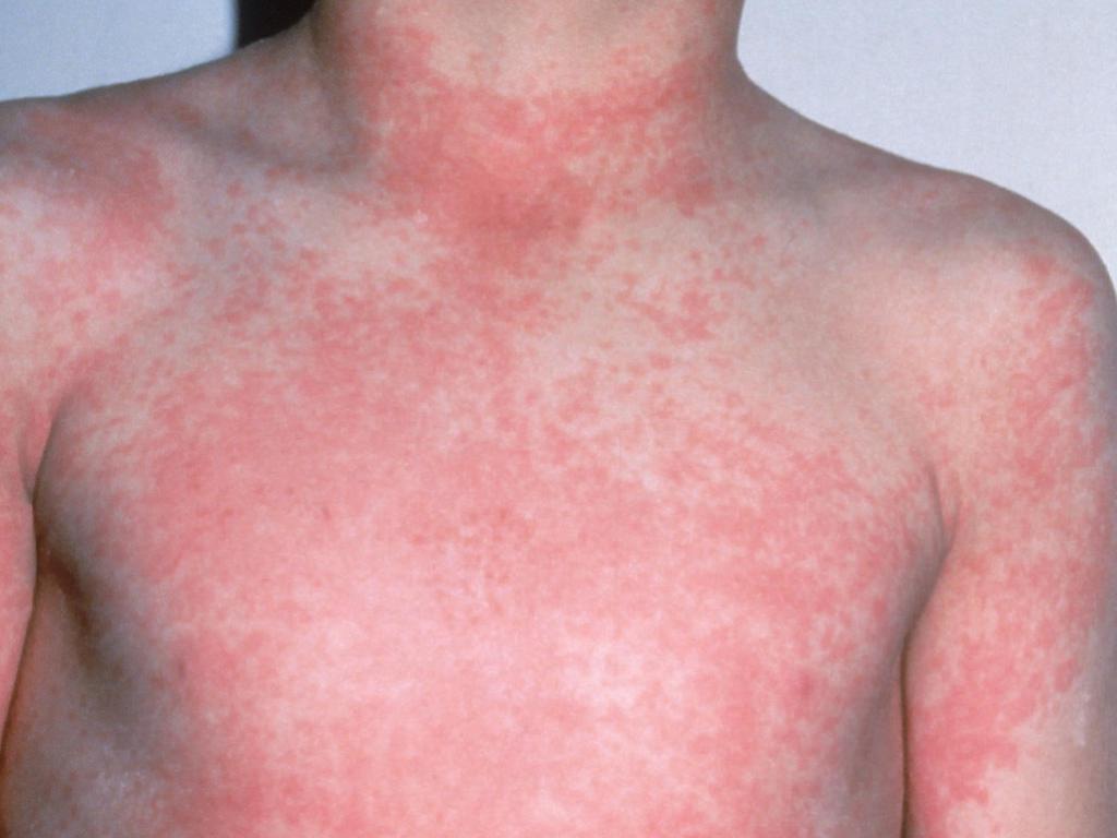 the Signs of the disease scarlet fever in children