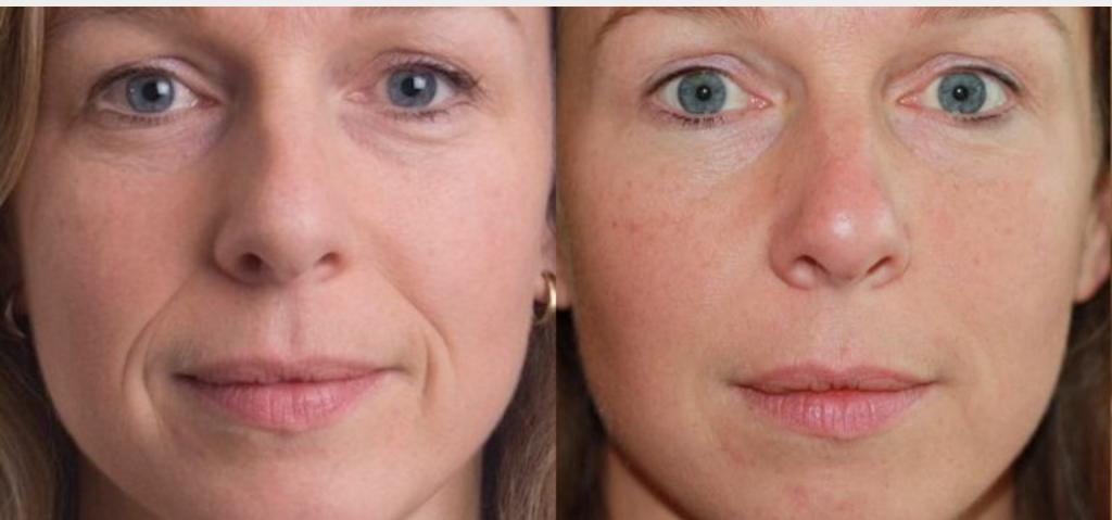 facelift without surgery