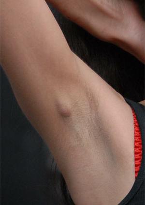 vergrößerte Lymphknoten unter dem arm