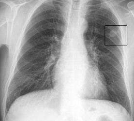 x-射线将显示肺癌