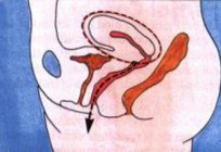 阴道子宫切除手术-说明行为及其后果