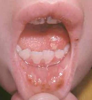aphthous stomatitis in child treatment