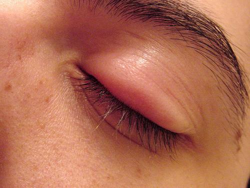 jak usunąć obrzęk oczu