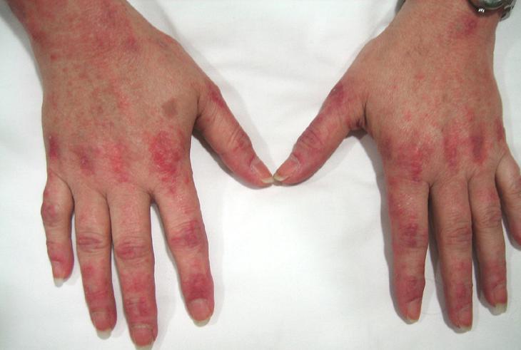 como curar eczema em suas mãos