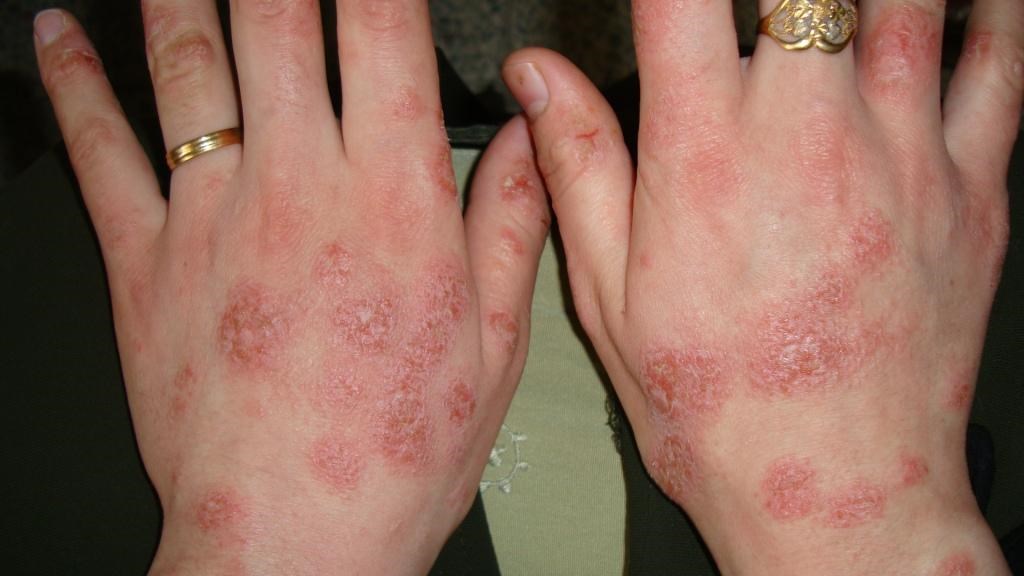 servicio de eczema en las manos de un tratamiento
