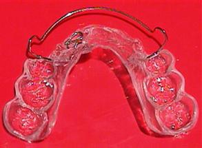 हटाने योग्य orthodontic उपकरण