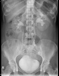 an x-ray of the kidney