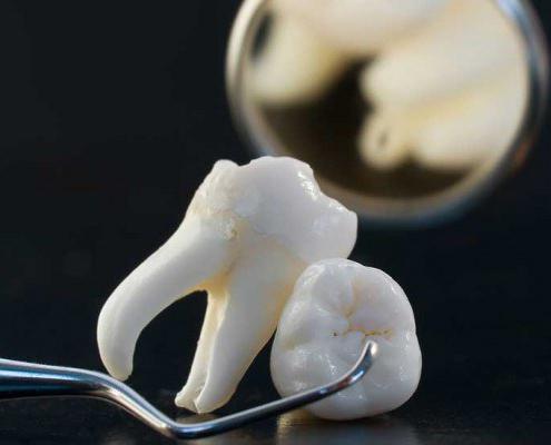 boli czy usuwać korzenie zniszczonego zęba