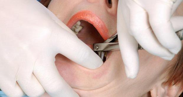 wie zu entfernen Wurzel des Zahnes wenn der zahn zerstört Häuser