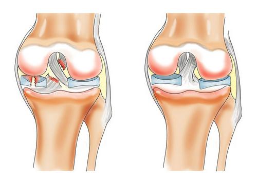 osteoarthritis of the knee treatment at home