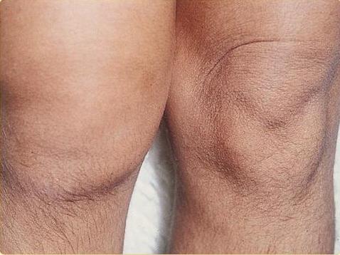 chondroprotectorsに変形性関節症の膝