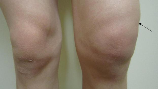 мазь при артрозі колінного суглоба
