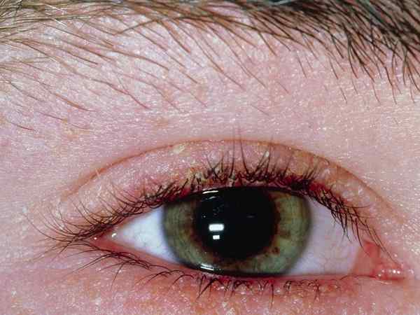 chloramphenicol eye usage instructions