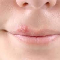 Lippenherpes bei Kindern Behandlung