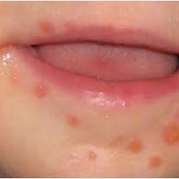 herpes virus in children