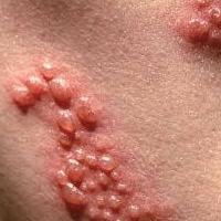 herpes in a child of 1 year