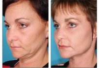 Laser resurfacing twarzy: wskazania i przeciwwskazania, pielęgnacja po zabiegu, wady i zalety, opinie