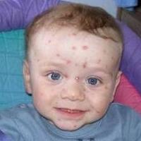 the first signs of chickenpox in a child