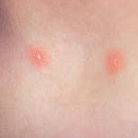 what are the signs of chickenpox