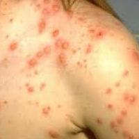 chickenpox first signs of photo