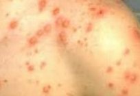 How to recognize the first signs of chickenpox in a child
