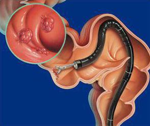 la sigmoidoscopia y la colonoscopia intestinal