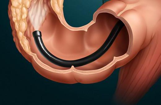 乙状结肠和结肠镜检查差异