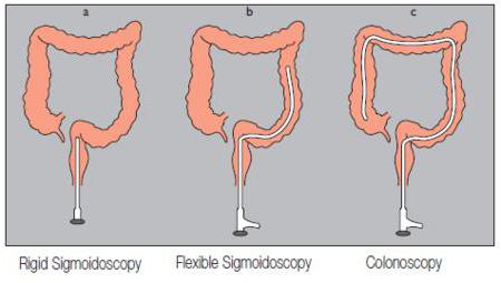 sigmoidoscopy और कोलोनोस्कोपी मतभेद