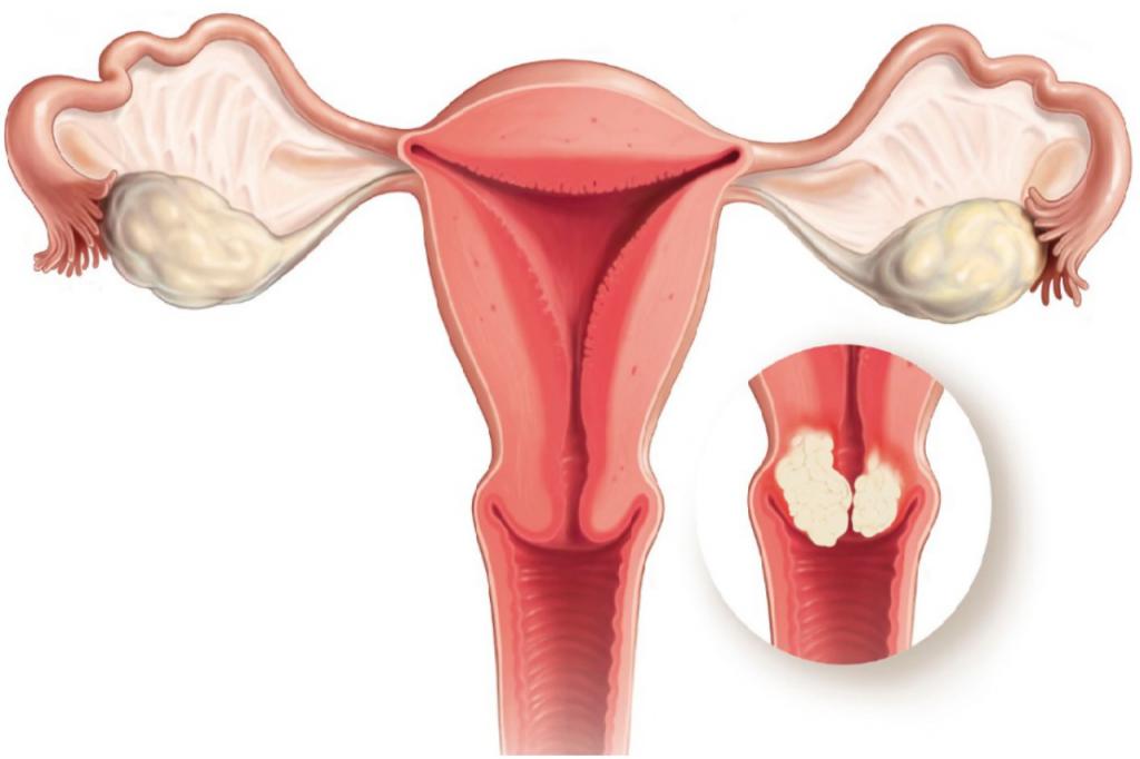 el cáncer de cuello uterino etapa