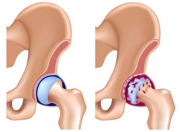 osteoarthritis of 1 degree of the hip treatment
